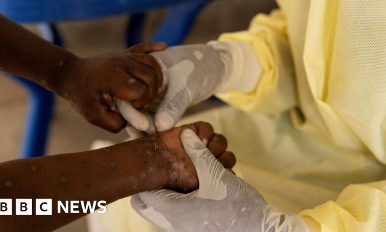 First case of more contagious mpox detected outside Africa