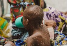 Mpox: Equitable vaccine access is crucial for the Global South