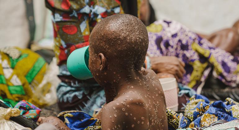 Mpox: Equitable vaccine access is crucial for the Global South